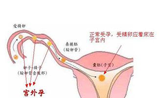 试管婴儿