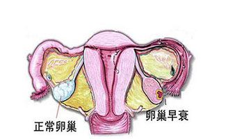 卵巢早衰需不需要做泰国试管婴儿