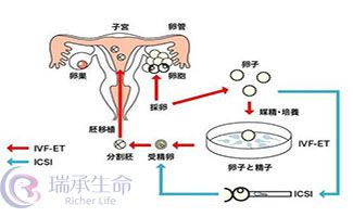 做第三代泰国试管婴儿的几个步骤你需要知道