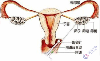 试管婴儿过程卵子是如何取出来？