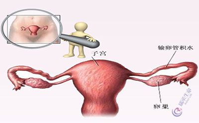 输卵管积水