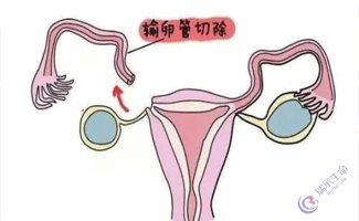 双侧输卵管切除做试管婴儿多少钱