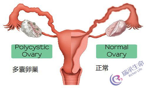 多囊卵巢111.jpg