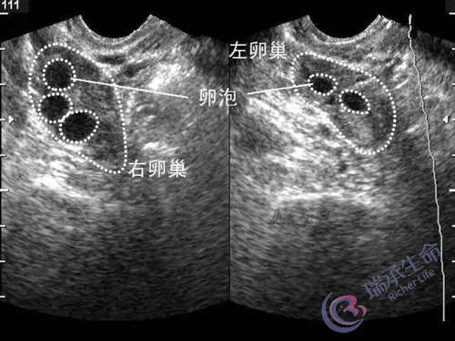 B超看窦卵泡数量.jpg
