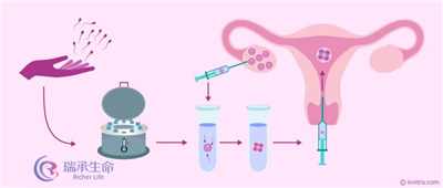 试管婴儿过程