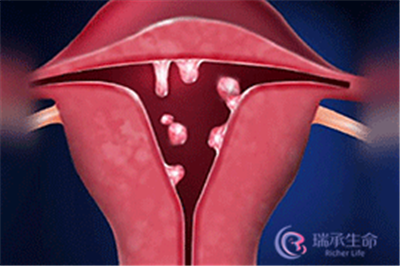 子宫内膜息肉为什么会影响女性的生育能力？