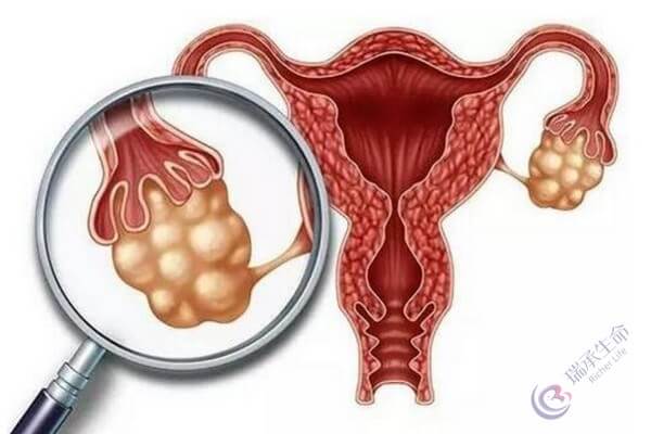 试管婴儿前检查有卵巢囊肿，有卵巢囊肿可以移植胚胎吗