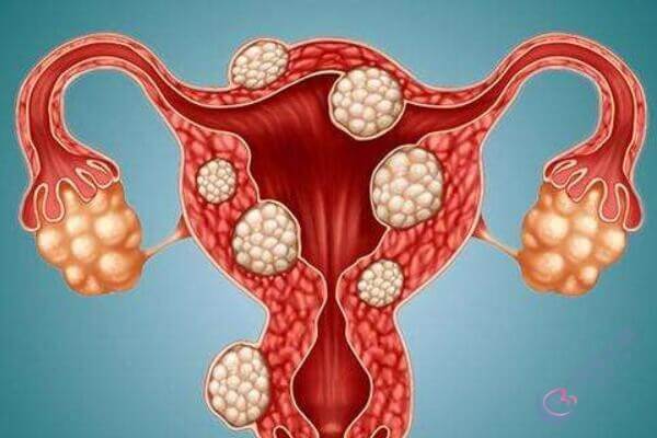 子宫肌瘤在什么情况下会试管婴儿成功率会高？