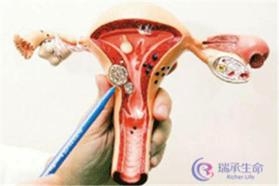 子宫肌瘤什么情况下会影响试管婴儿成功率？
