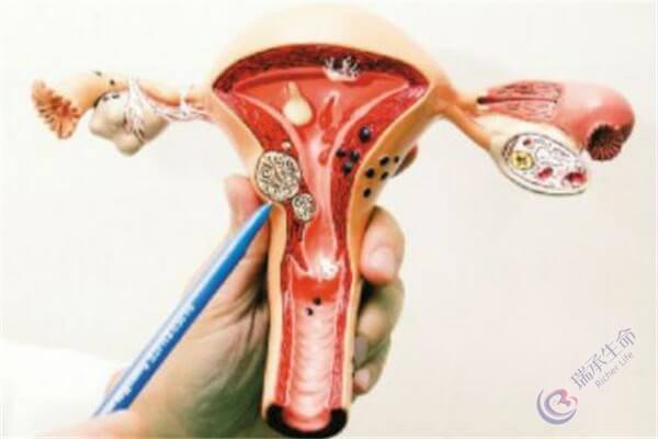 子宫肌瘤什么情况下会影响试管婴儿成功率？
