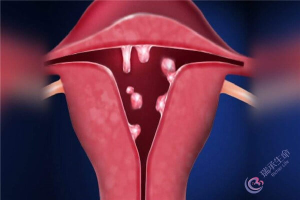子宫内膜息肉致生育路受阻，试管婴儿如何实现好孕?