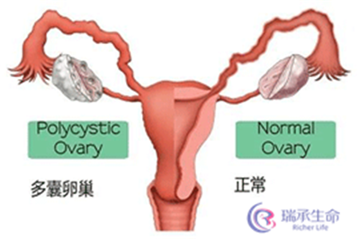 多囊卵巢做试管婴儿和普通试管婴儿有哪些不一样？