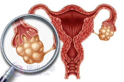 卵巢囊肿致不孕，切除可能会损害卵巢？该如何好孕？