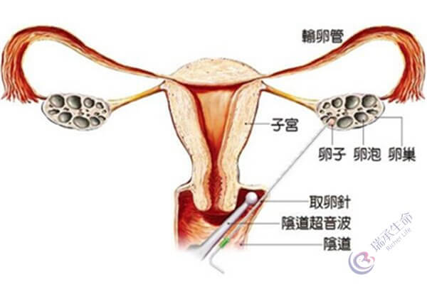 【试管婴儿取卵】关于这些，你都清楚吗？