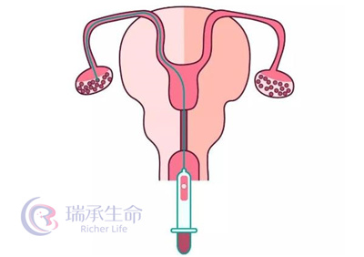 试管婴儿取卵后，需要注意哪些问题？