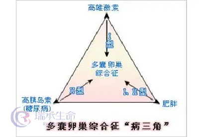 多囊卵巢综合征的诊断与治疗的详细解读