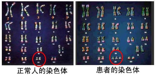 高龄备孕遇上胚胎染色体异常怎么办？