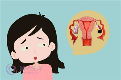 试管备孕遇上巧囊，应该怎么办？是先试管还是先手术？