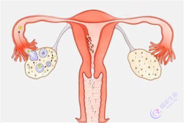 多囊卵巢致不孕，试管婴儿方案助孕力重燃