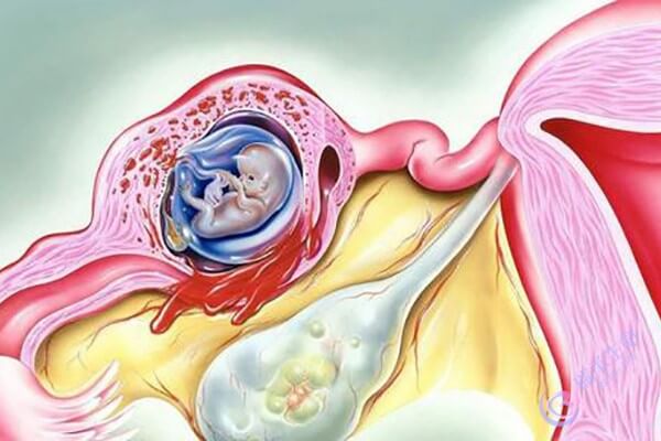 多次宫外孕怎么办，做试管如何才能正常怀孕