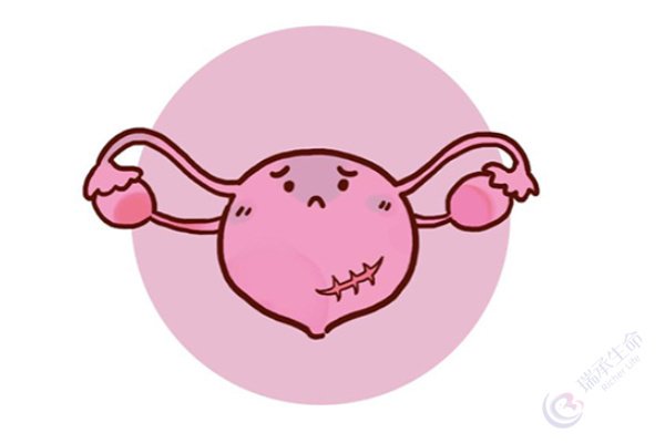 疤痕子宫——再次做试管，建议一次移植几个胚胎？