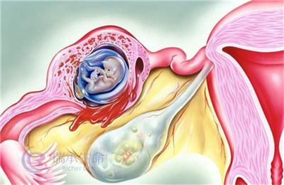 做了试管婴儿，还发生宫外孕的概率有多少？
