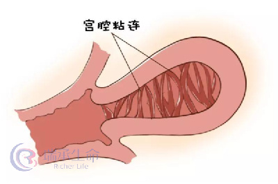 关于轻度、中度、重度宫腔粘连做试管的成功率