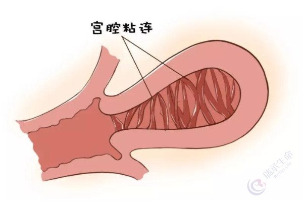 关于轻度、中度、重度宫腔粘连做试管的成功率