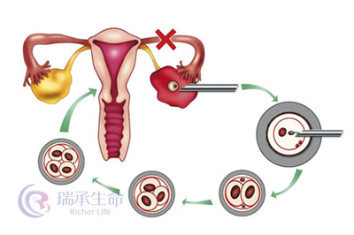 卵巢囊肿女性做试管婴儿能否取到优质卵子？