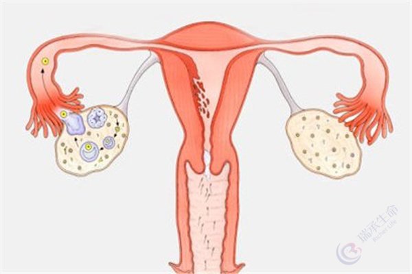 多囊卵巢综合征做试管婴儿需要注意什么？