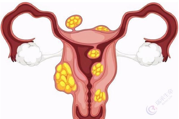 试管促排卵对女性的子宫肌瘤产生影响吗