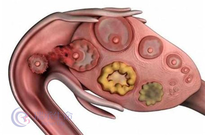分析卵泡监测数与取卵数不一致的原因