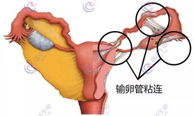 女性输卵管粘连能通过泰国试管技术正常怀孕吗？