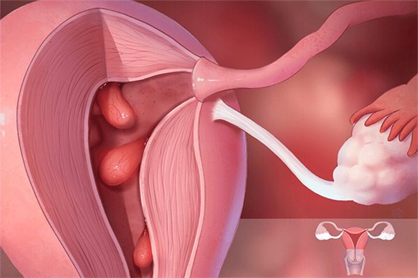 子宫内膜息肉是如何产生的？做试管会有影响吗？