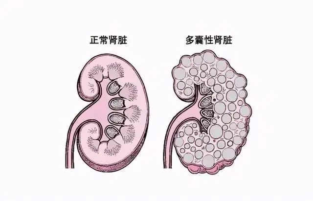 多囊肾对生育有何影响？可以做试管婴儿吗？