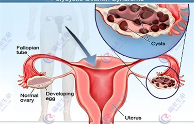 巧克力囊肿做试管对促排取卵有没有影响？