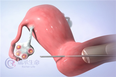 担心取卵后腹水?瑞承生命教您有效预防