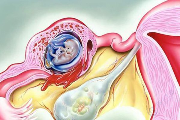 做试管婴儿能可以避免宫外孕吗？如何提高着床率