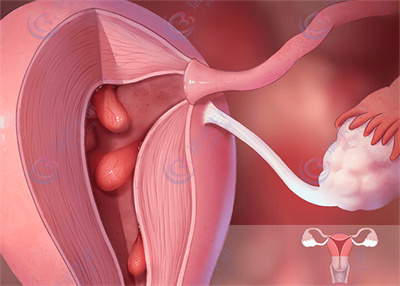 子宫内膜息肉致生育路受阻，如何实现好孕?