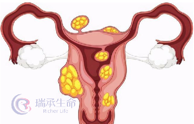 子宫肌瘤影响泰国试管婴儿成功率吗?