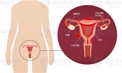 子宫内膜异位症去泰国做试管婴儿成功率高吗？