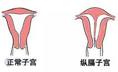 子宫纵膈试管自行怀孕可行吗？生育出路在哪儿？