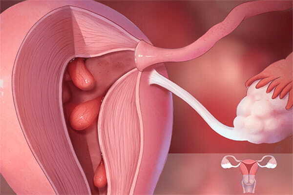 子宫内膜息肉会对妊娠有哪些影响?如何做试管？