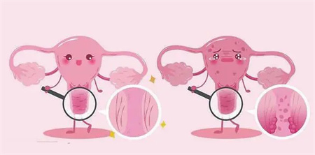 宫颈糜烂对女性有危害吗？对做试管婴儿有影响吗？