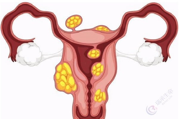 子宫腺肌症真的很难怀孕吗？移植前怎么调理？