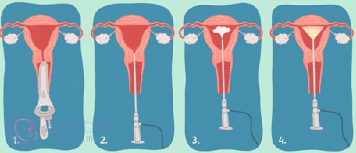 试管婴儿|移植之前为什么要做宫腔灌注呢？