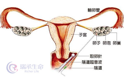 患有阴道炎做试管婴儿会影响取卵结果吗？