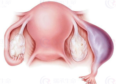 输卵管囊肿是否会影响胚胎移植?有何好孕之策?