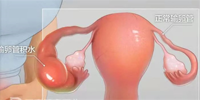 患有输卵管积液做试管婴儿有哪些注意事项？