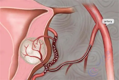 患有子宫内膜异位症是否可以做试管婴儿？